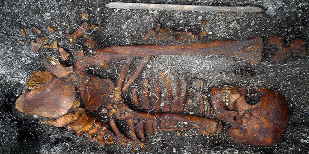 Syphilis-ähnliche Erkrankungen haben sich bereits vor Kolumbus in Amerika ausgebreitet